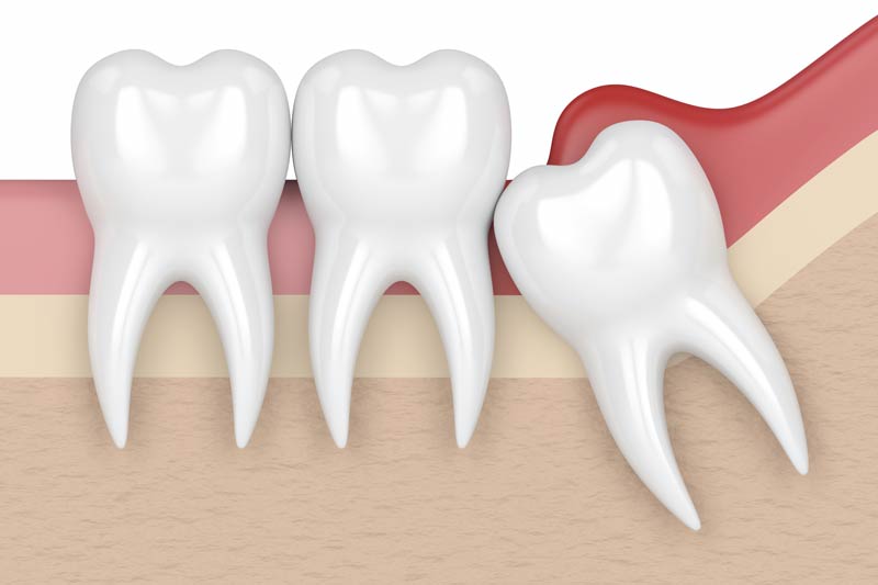 Wisdom Tooth Removal in Glendale